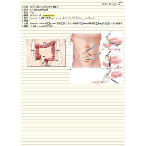 腹腔鏡闌尾切除
