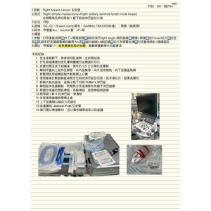 右側單純乳房切除術＋腋下前哨淋巴結切片術