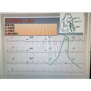 速記 冠狀動脈阻塞 心電圖