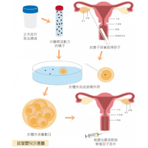試管嬰兒流程