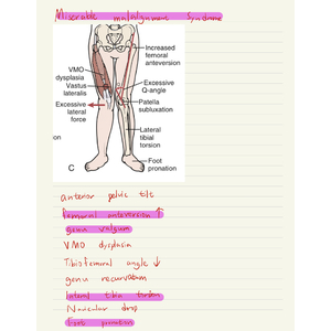 下肢miserable malailgnment syndrome